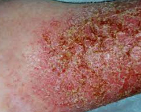 atopic dermatitis infection